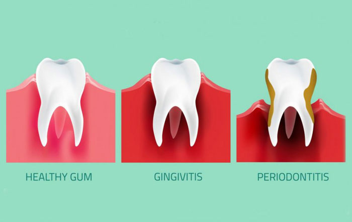 Gum Disease