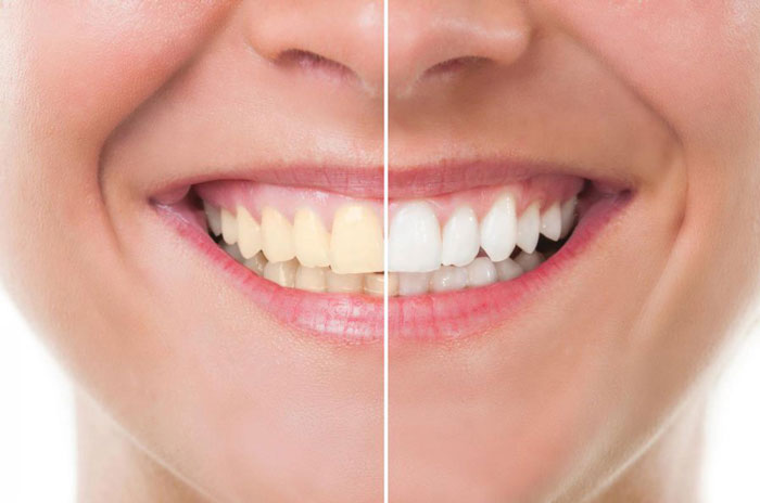 Before after image of Teeth Whitening