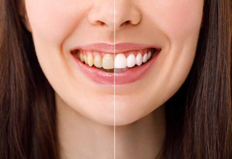 Teeth whitening after and at results by Hawthorn Dental, featuring a radiant smile in St. Louis, MO